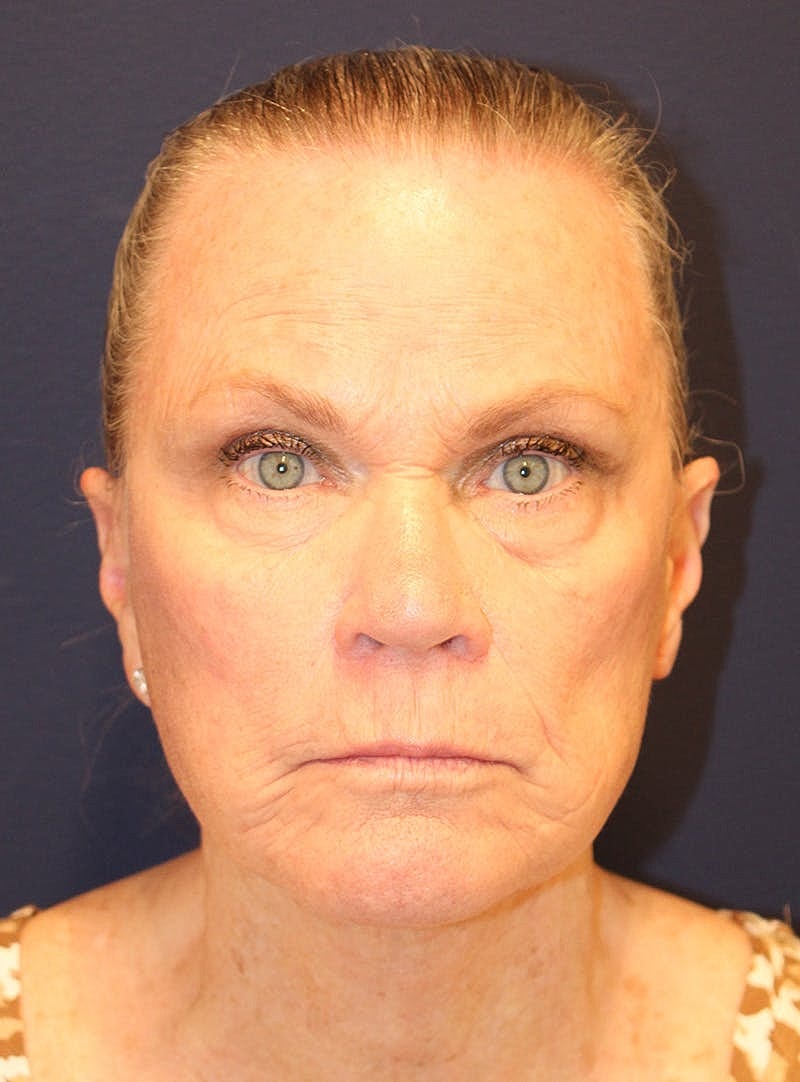 Peels Before & After