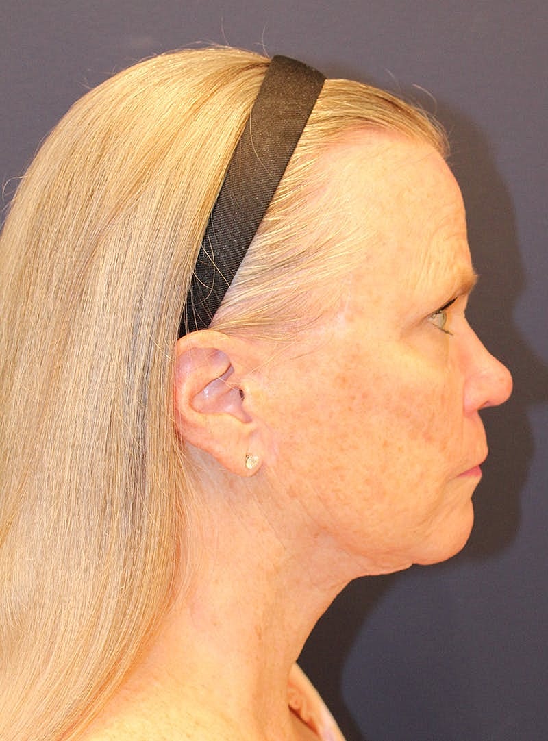 Peels Before & After