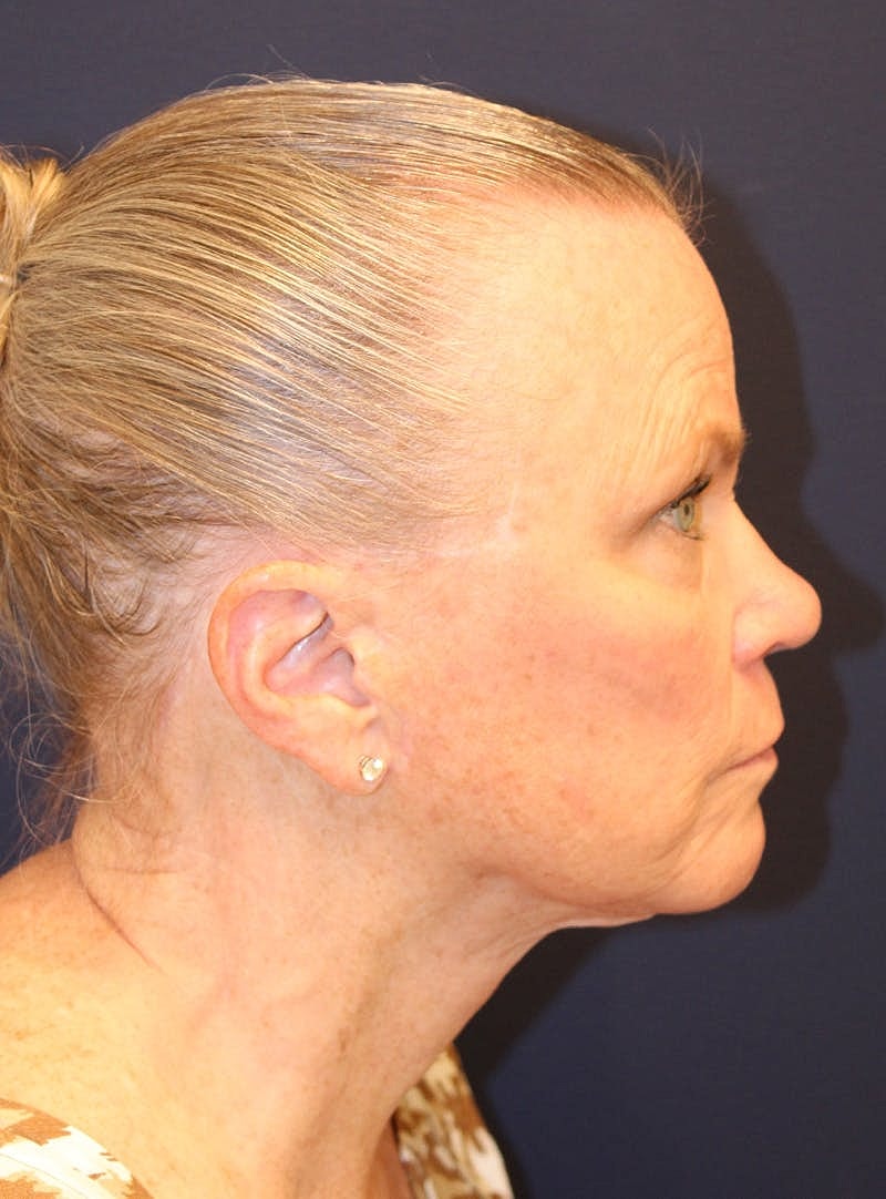 Peels Before & After