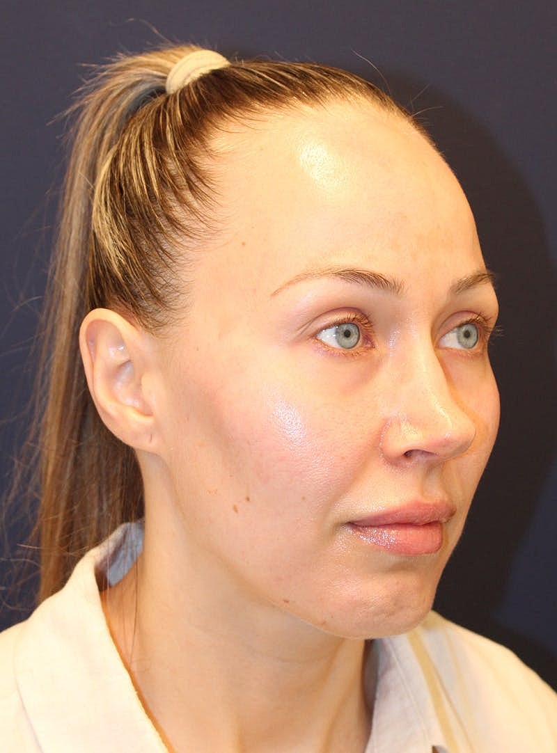 Peels Before & After