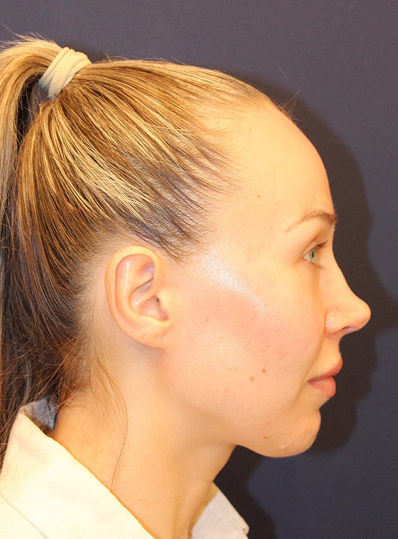 Peels Before & After