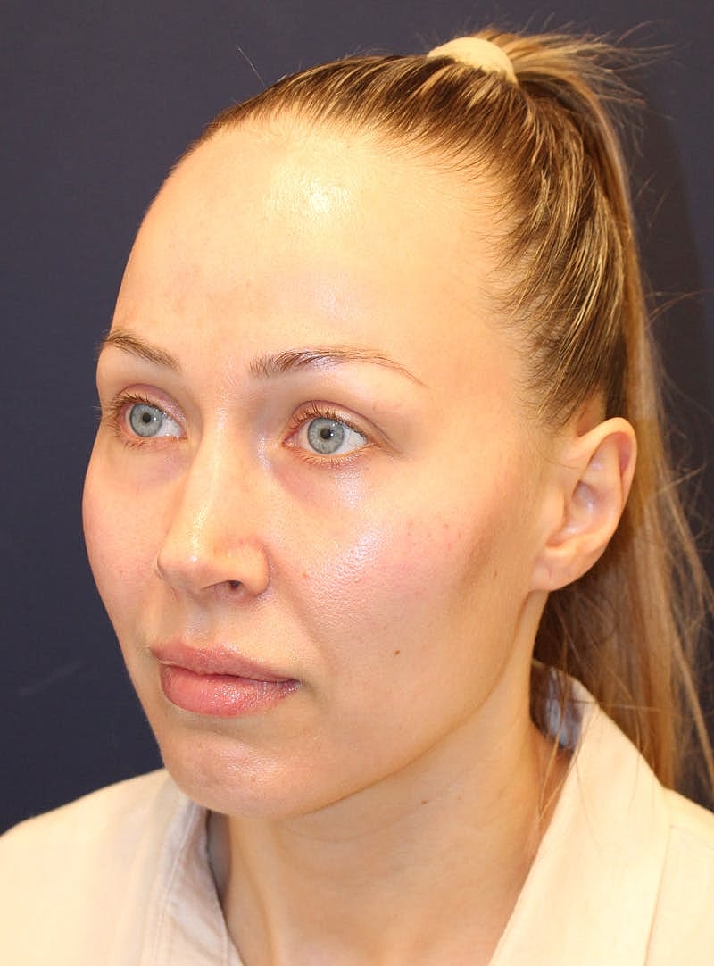 Peels Before & After