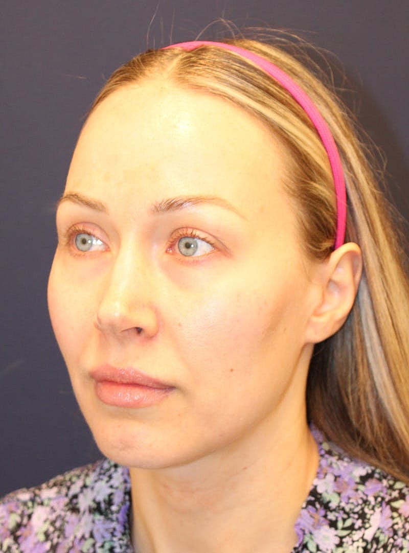 Peels Before & After