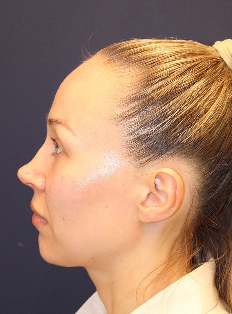 Peels Before & After