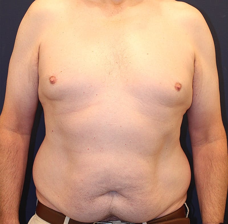 Emsculpt Neo Before & After