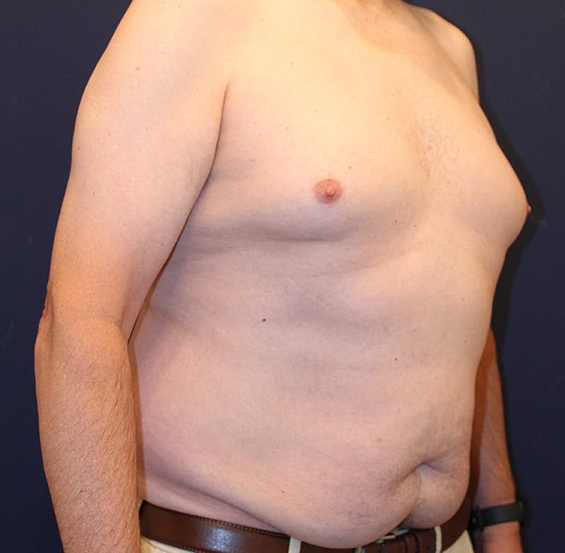 Emsculpt Neo Before & After