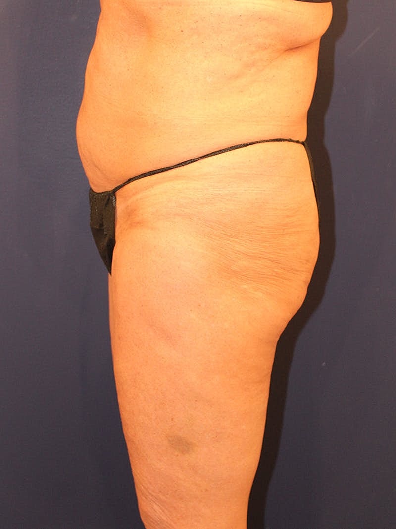 Emsculpt Neo Before & After