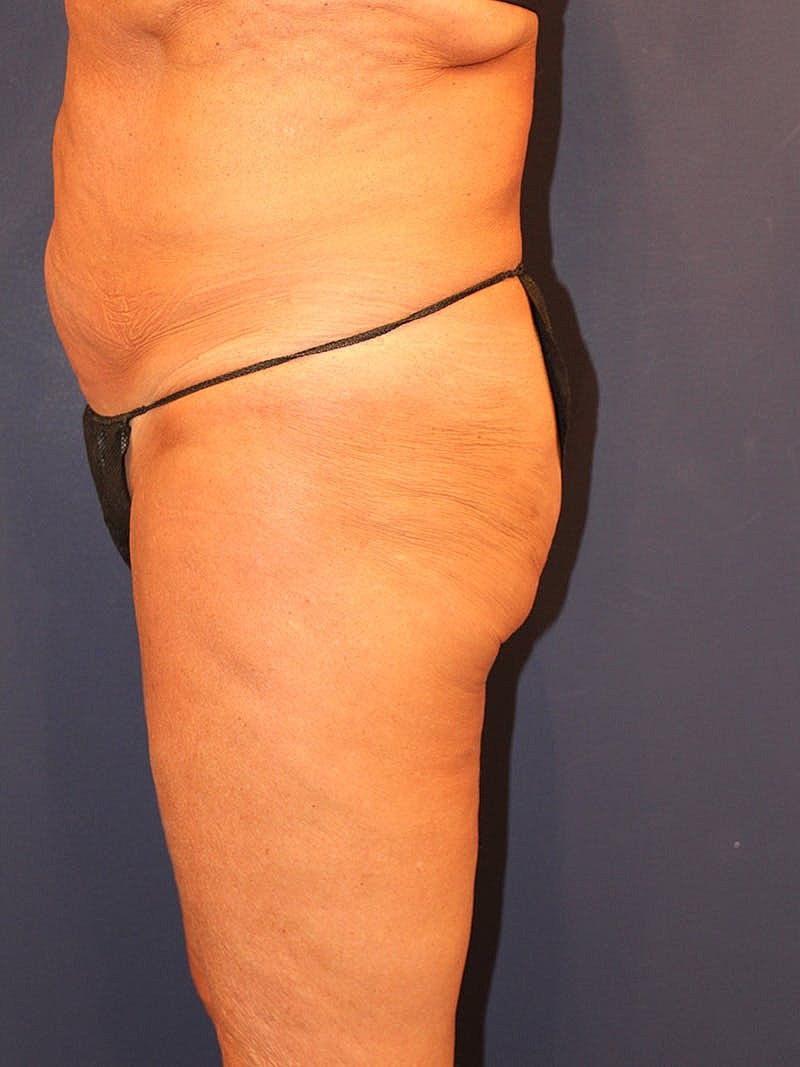 Emsculpt Neo Before & After