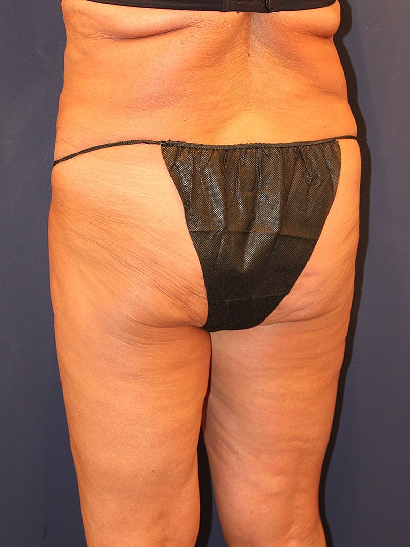 Emsculpt Neo Before & After