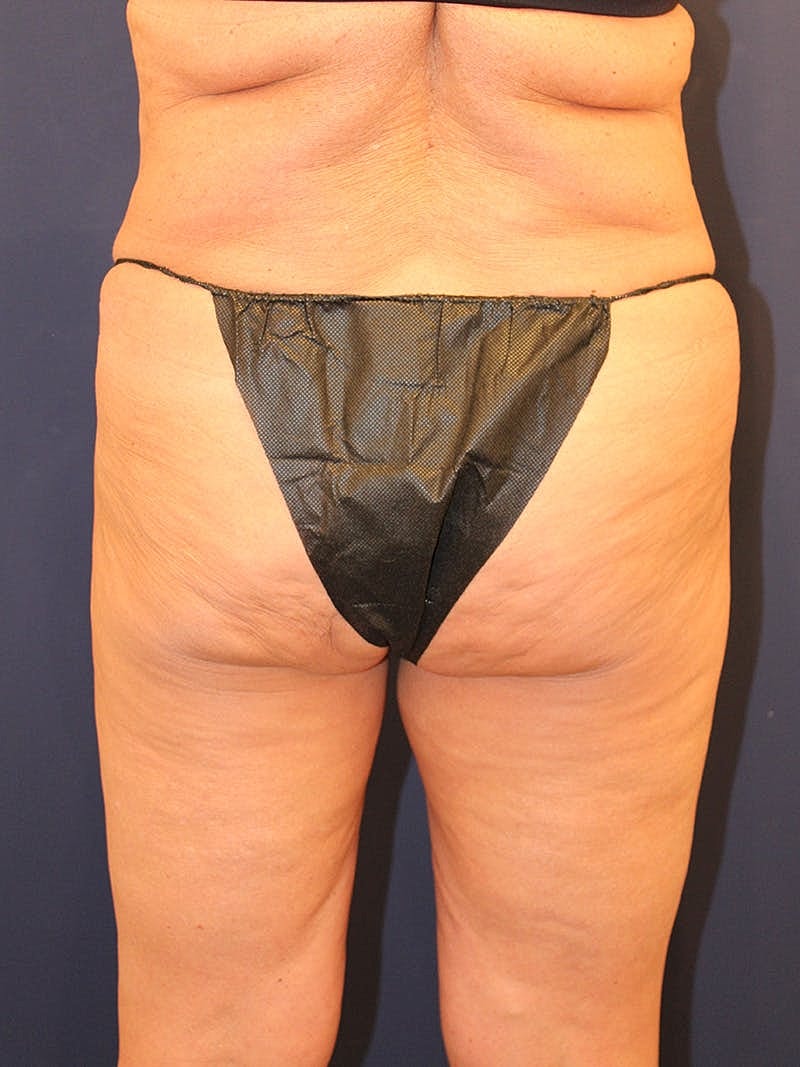 Emsculpt Neo Before & After