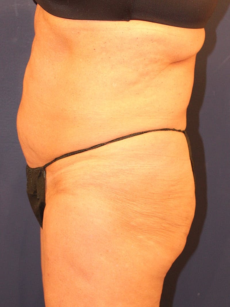 Emsculpt Neo Before & After