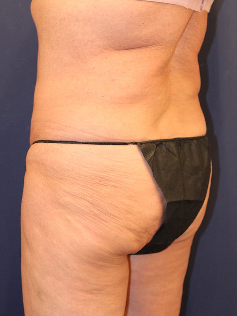 Emsculpt Neo Before & After