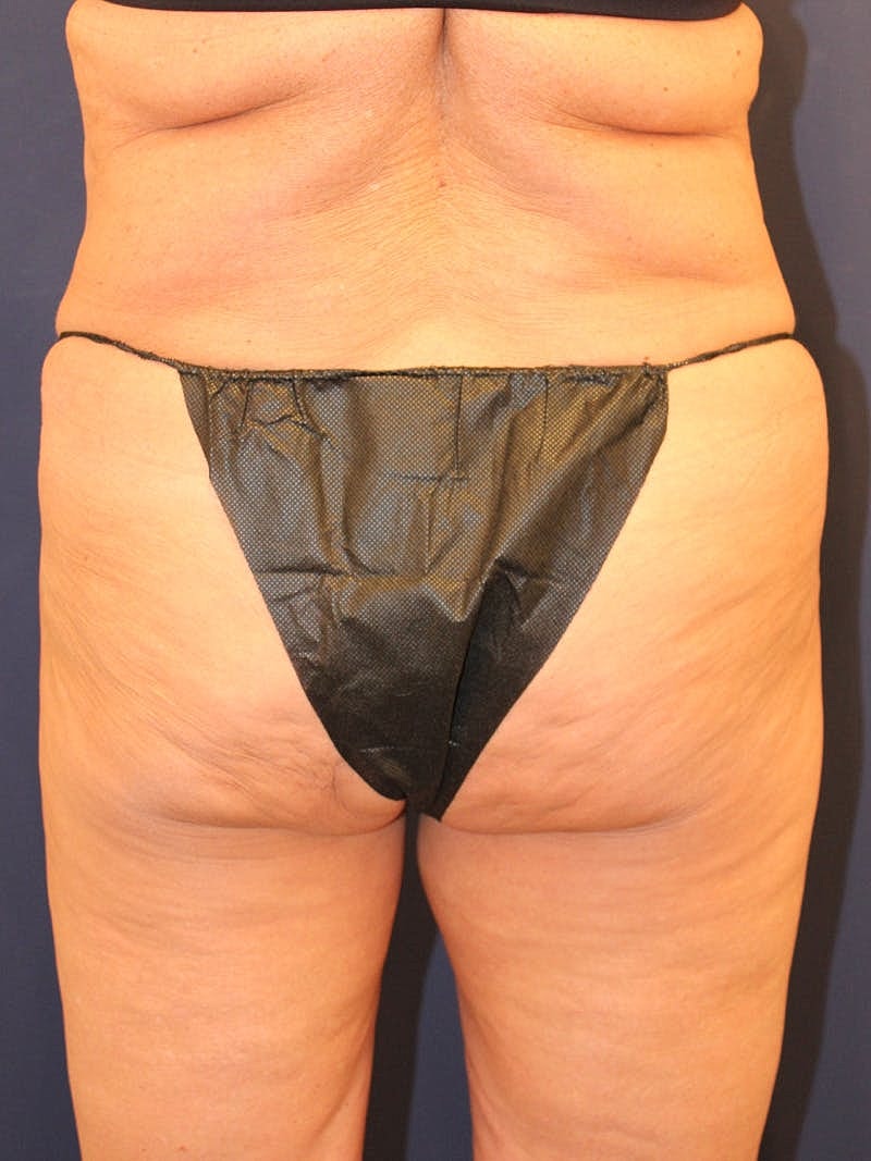 Emsculpt Neo Before & After