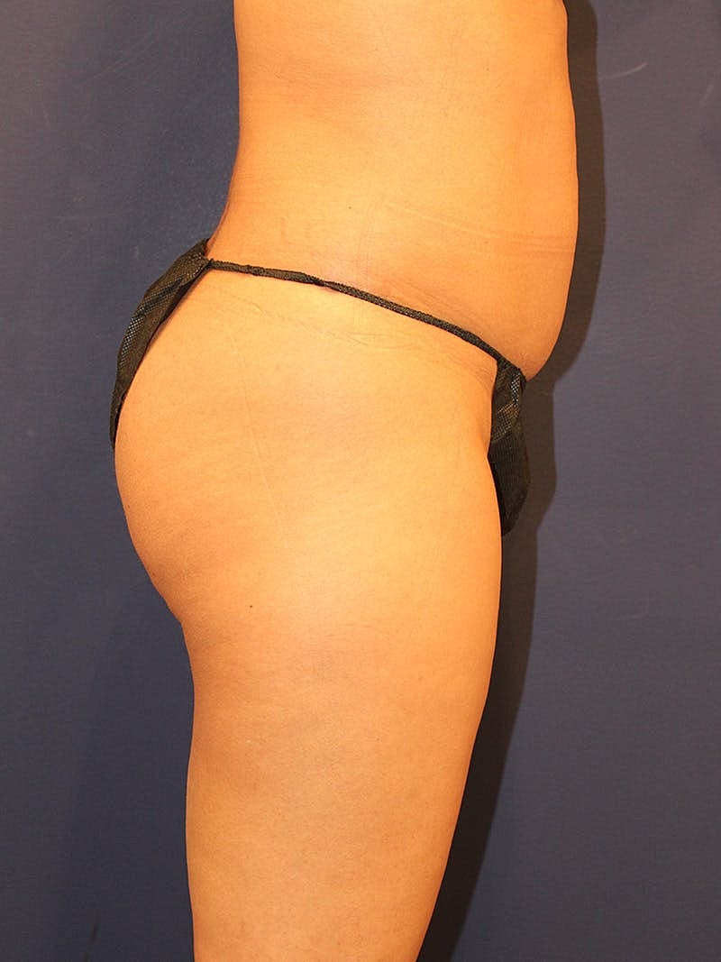 Emsculpt Neo Before & After