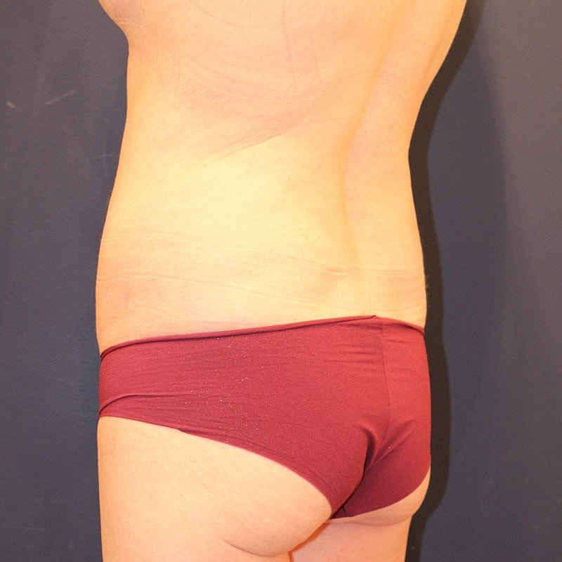 Emsculpt Neo Gallery Before & After