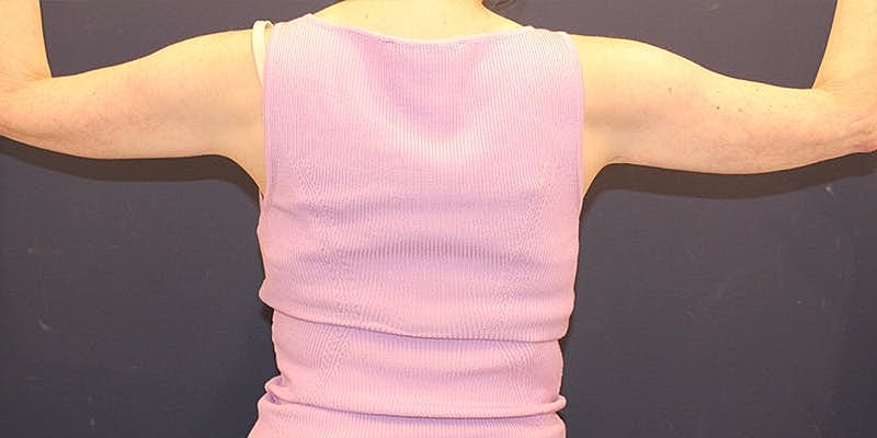 Emsculpt Neo Before & After