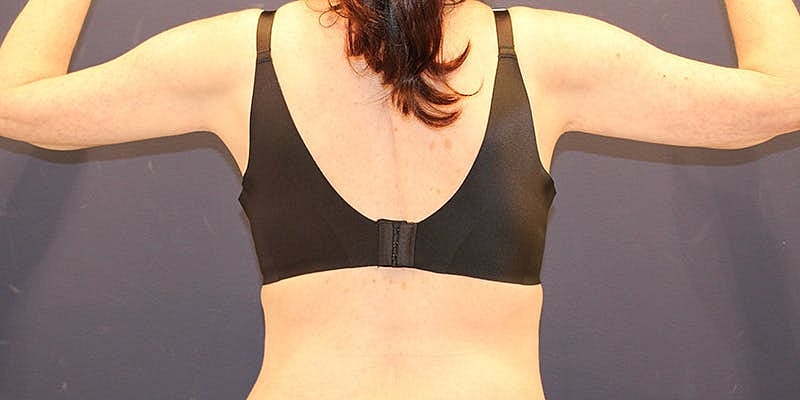 Emsculpt Neo Before & After