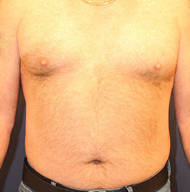 Emsculpt Neo Before & After