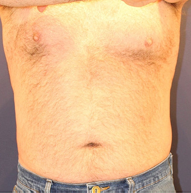 Emsculpt Neo Before & After