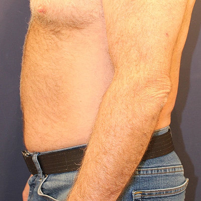 Emsculpt Neo Before & After