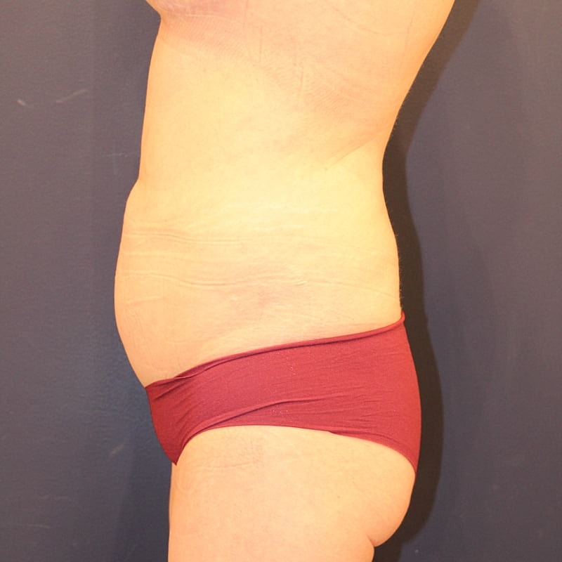 Emsculpt Neo Gallery Before & After