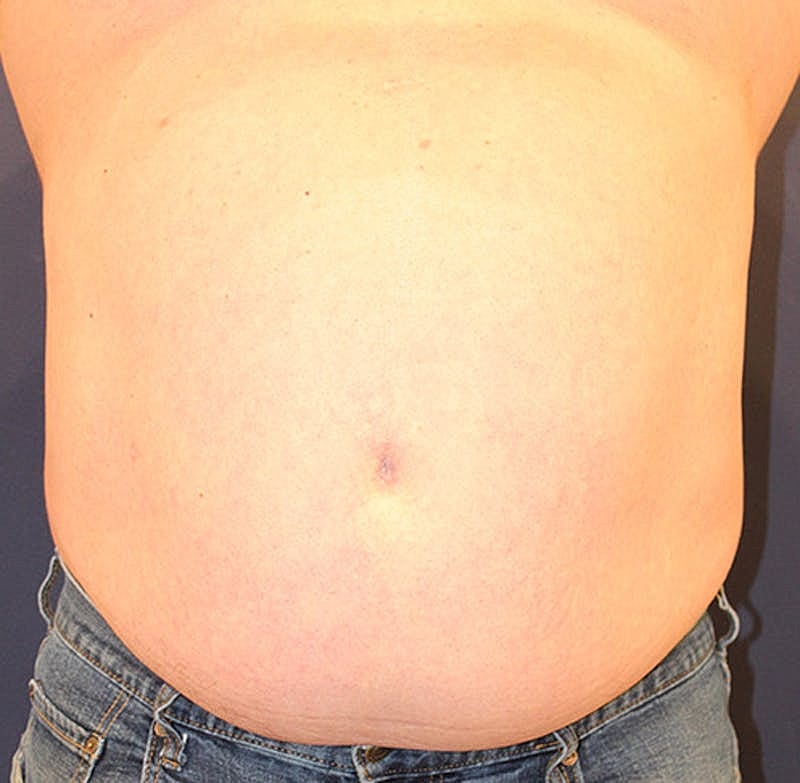 Emsculpt Neo Before & After