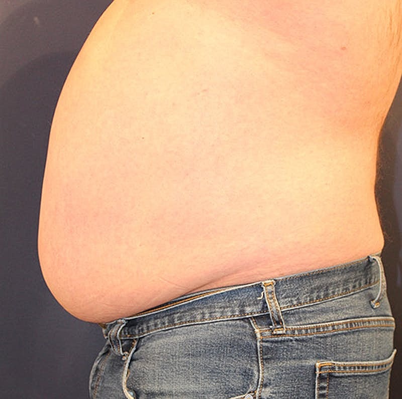 Emsculpt Neo Before & After