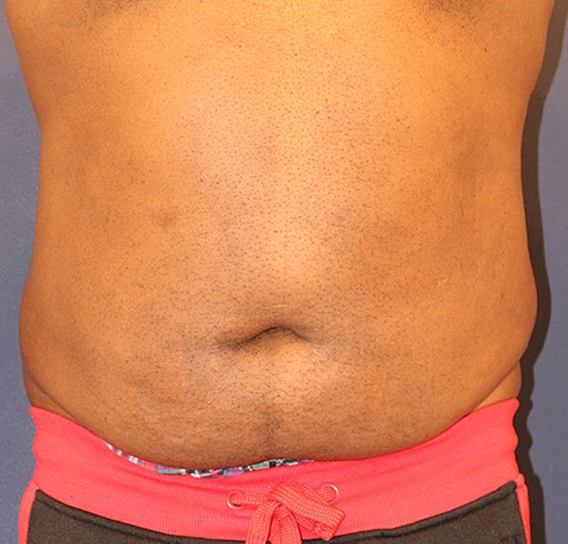 Emsculpt Neo Before & After