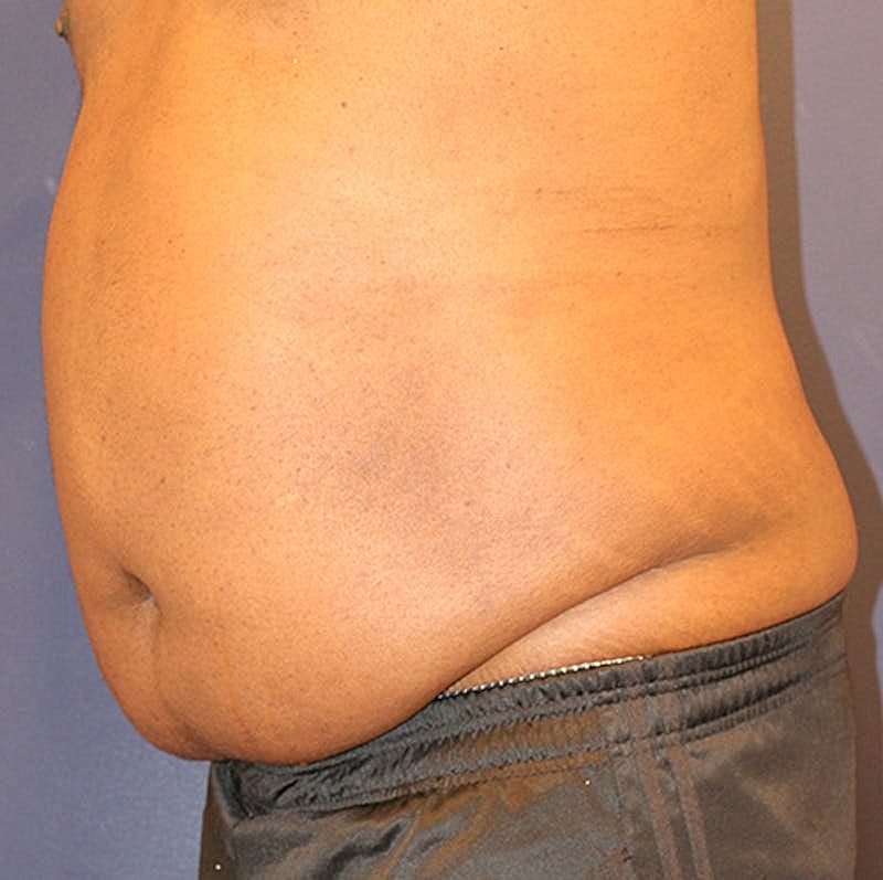 Emsculpt Neo Before & After