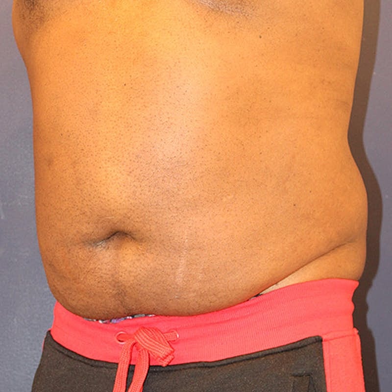 Emsculpt Neo Before & After