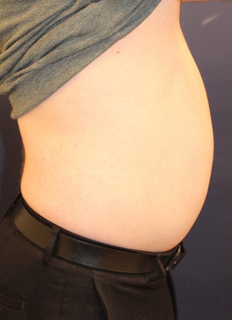 Emsculpt Neo Gallery Before & After