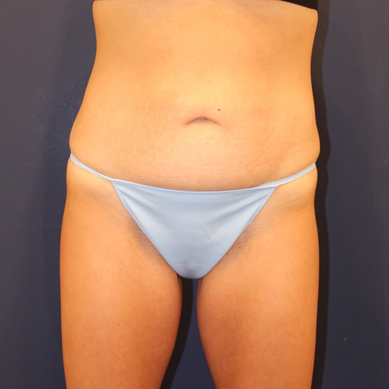 Emsculpt Neo Gallery Before & After