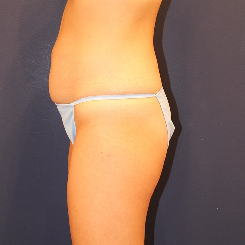 Emsculpt Neo Gallery Before & After