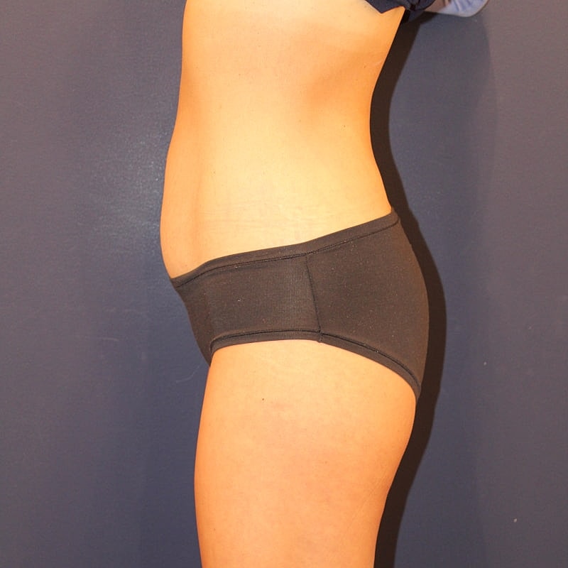 Emsculpt Neo Gallery Before & After