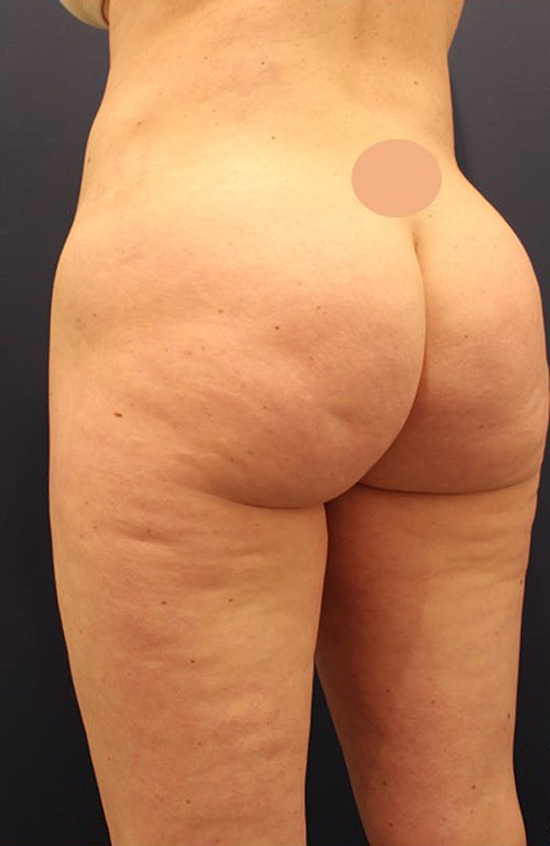Aveli Cellulite Treatment Before & After