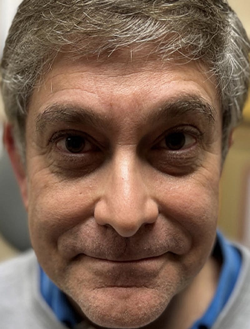 Botox Dysport Before & After