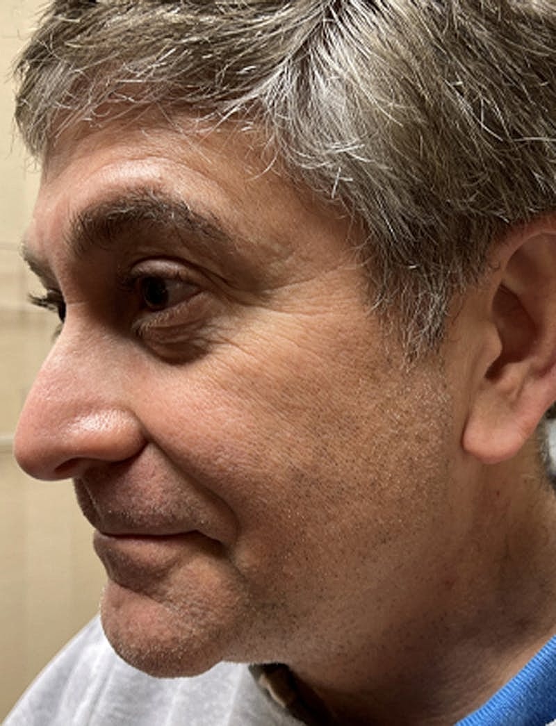 Botox Dysport Before & After