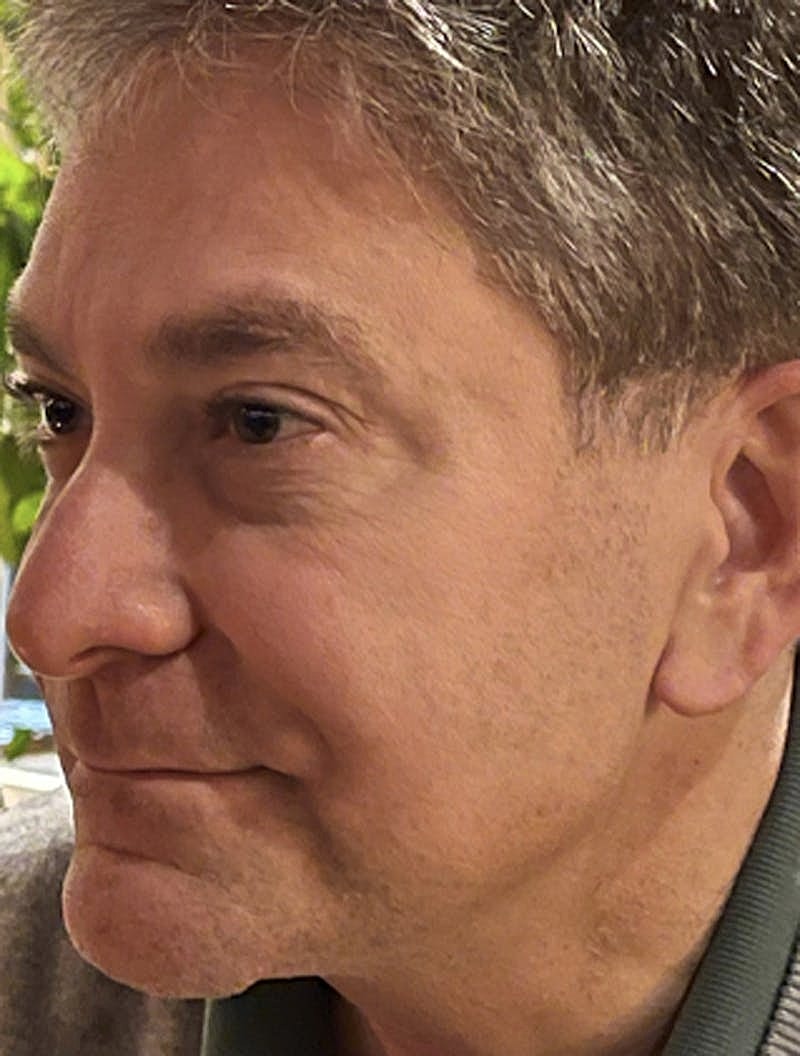 Botox Dysport Before & After