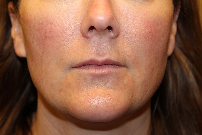 Botox Dysport Gallery Before & After