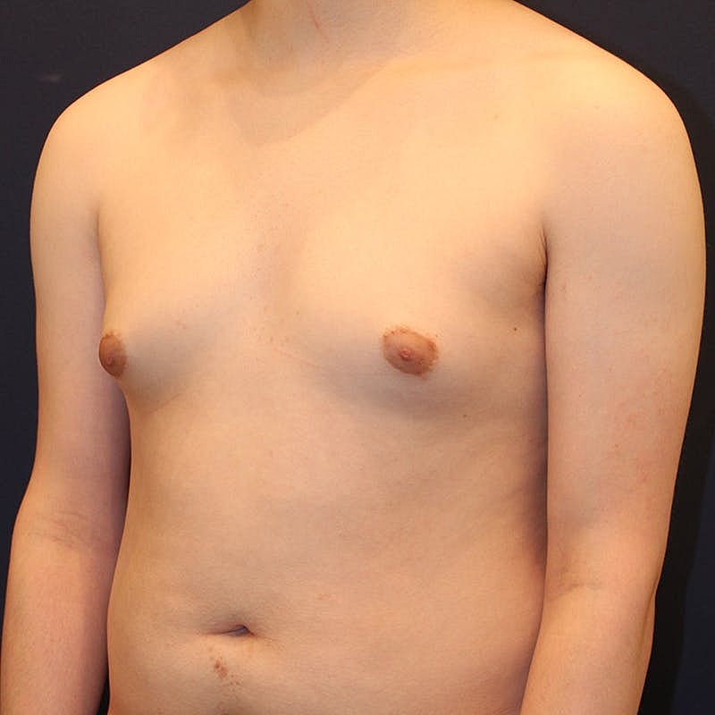 Male Breast Reduction Gynecomastia Before & After