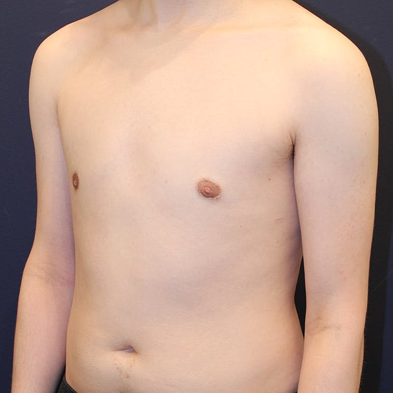 Male Breast Reduction Gynecomastia Before & After