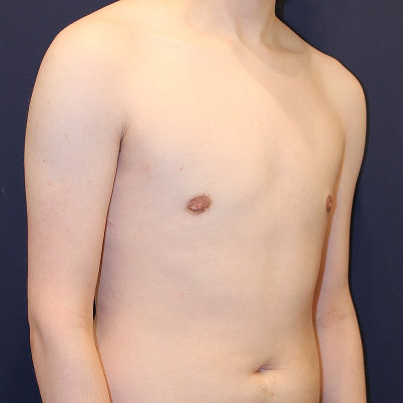 Male Breast Reduction Gynecomastia Before & After