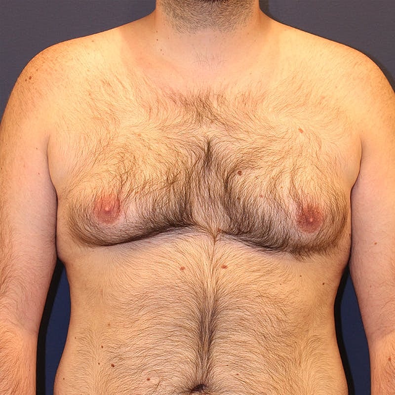 Male Breast Reduction Gynecomastia Before & After