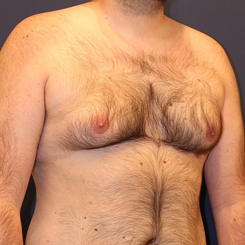 Male Breast Reduction Gynecomastia Before & After