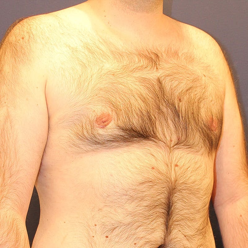 Male Breast Reduction Gynecomastia Before & After