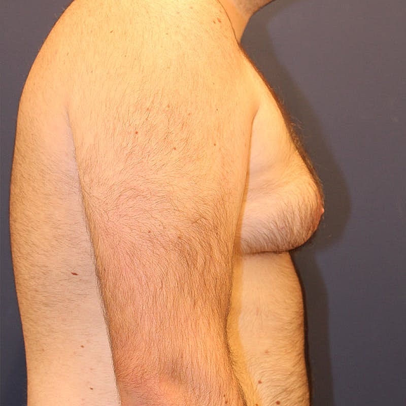 Male Breast Reduction Gynecomastia Before & After