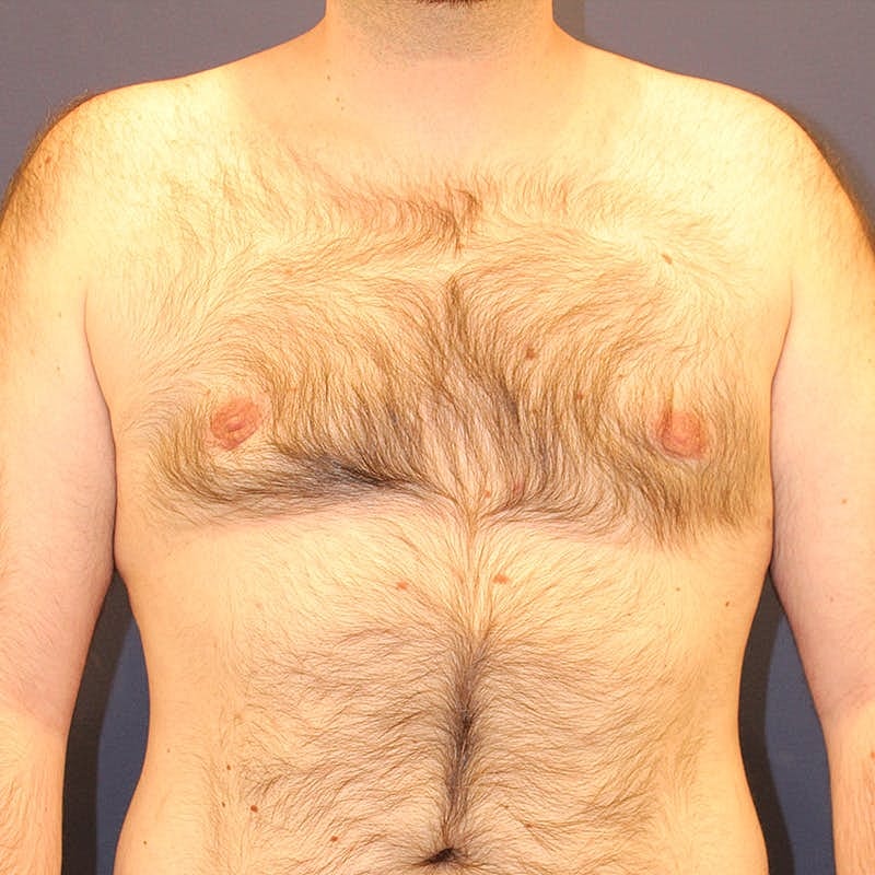 Male Breast Reduction Gynecomastia Before & After