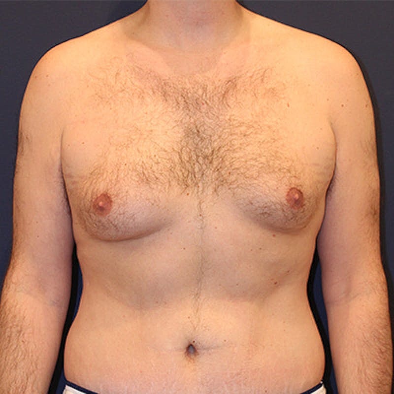 Male Breast Reduction Gynecomastia Before & After