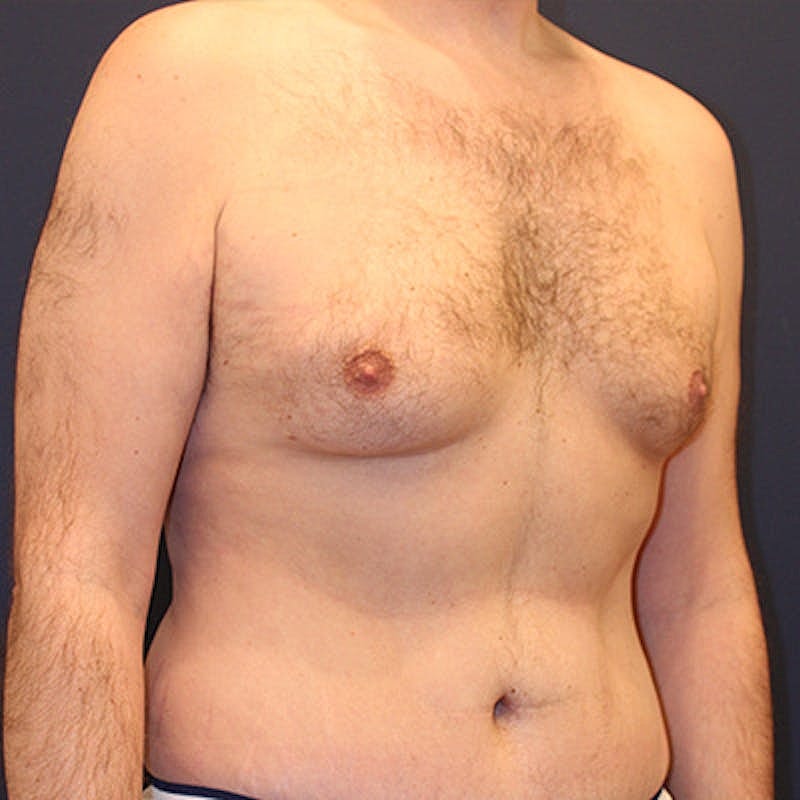 Male Breast Reduction Gynecomastia Before & After