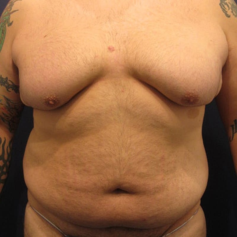 Male Breast Reduction Gynecomastia Before & After